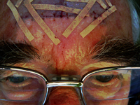 Paul's forehead after BCC exision